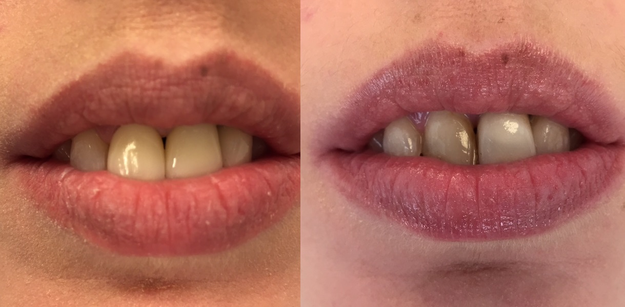 לפני טיפול ואחרי הלבנה וכתרים